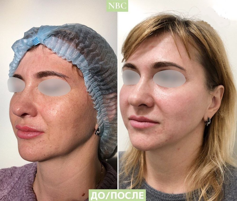 Пациентка клиники NBC до и после лазерной шлифовки кожи лица