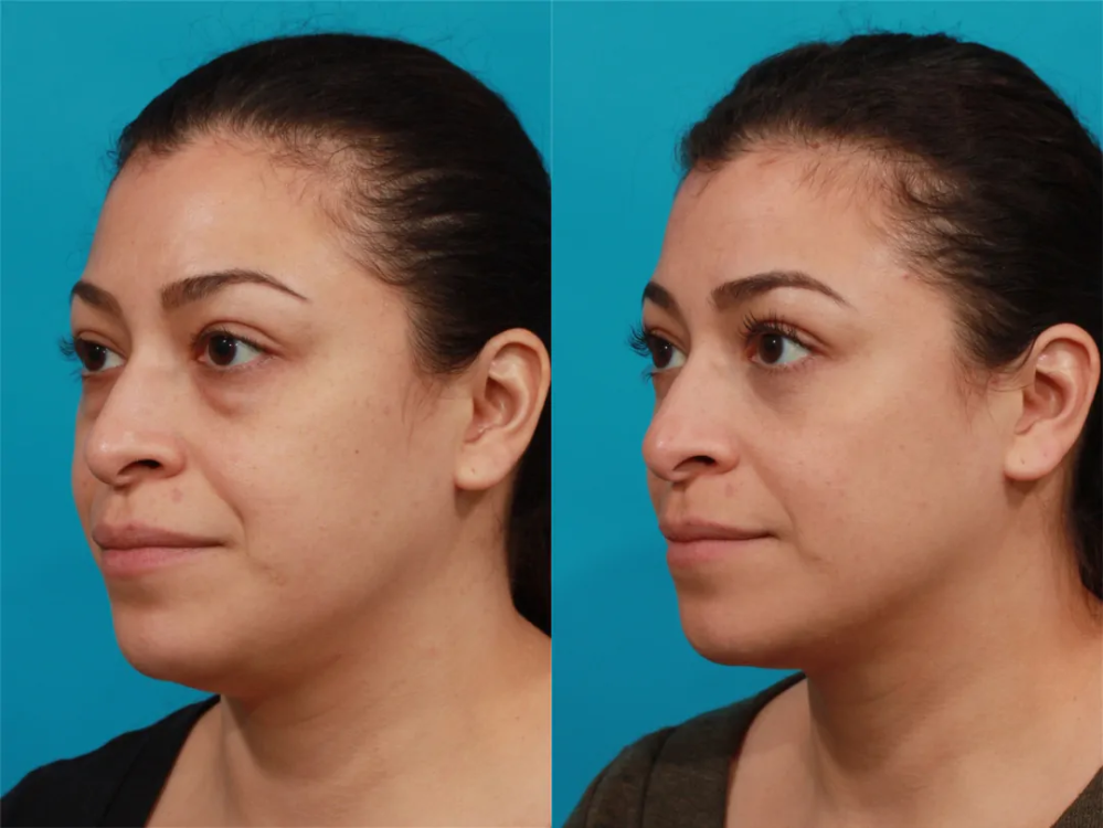 Пациентка доктора Гукаса Миракяна до и после пластики нижних век