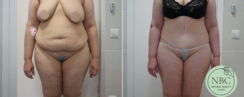 Пациентка пластического хирурга Арслана Пенаева до и после абдоминопластики