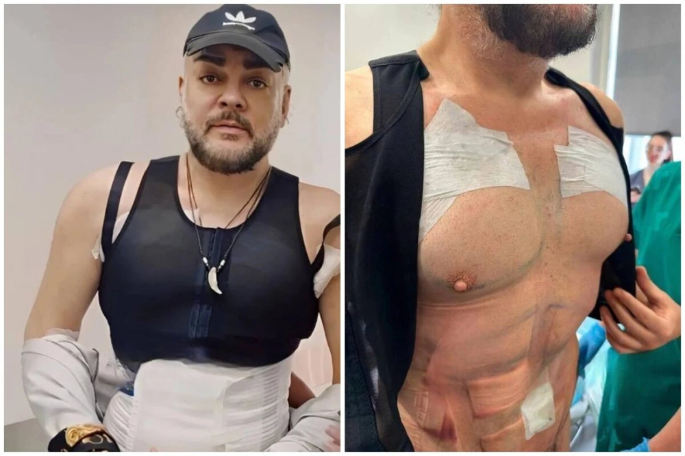 Абдоминопластика и липоскульптурирование тела у Филиппа Киркорова