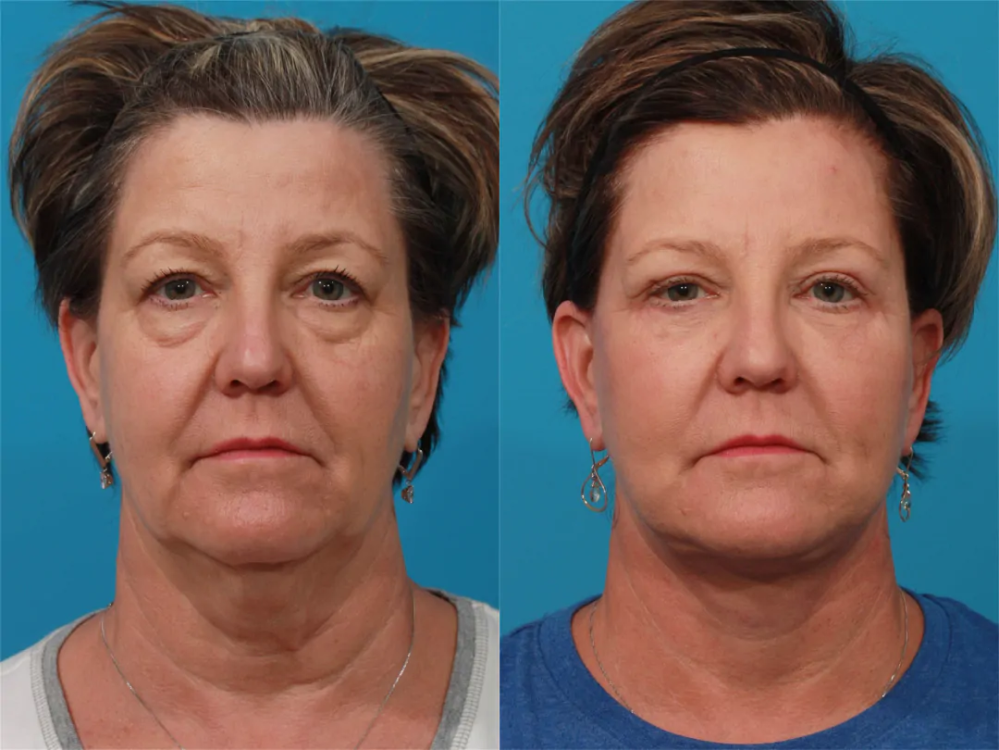 Пациентка пластического хирурга Гукаса Миракяна до и после подтяжки лица