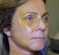 Реабилитация после эндоскопического лифтинга лба