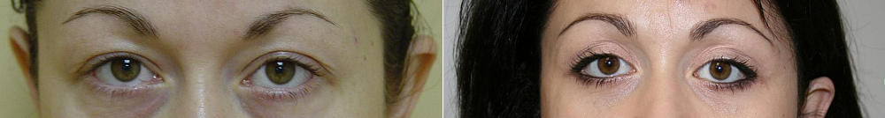 Пациентка профессора Арслана Пенаева. Фото до и после блефаропластики верхних и нижних век