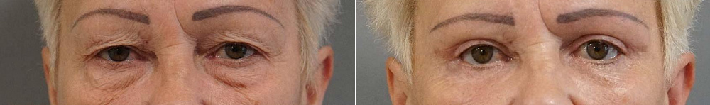 Пациентка профессора Арслана Пенаева. Фото до и после блефаропластики верхних и нижних век