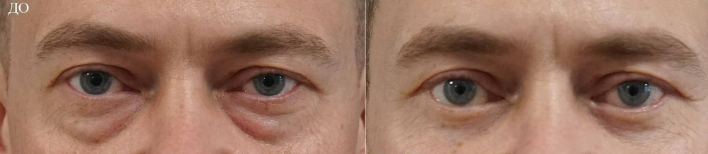 Пациент профессора Арслана Пенаева. Фото до и после блефаропластики нижних век и эндолазерного лифтинга  малярной области