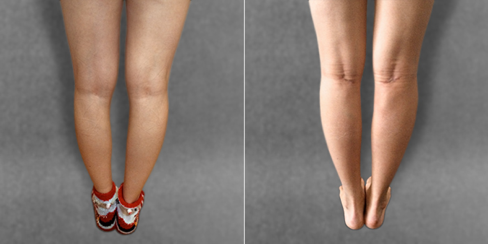 Пациентка Дмитрия Крысина до и после операции по коррекции голеней при помощи имплантатов