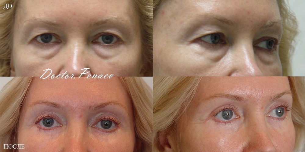 Пациентка доктора Пенаева. Фотография до и после блефаропластики верхних и нижних век