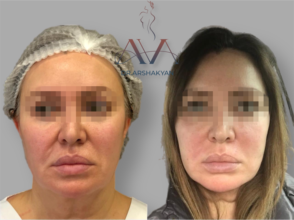 Пациентка пластического хирурга Вардана Аршакяна до и после омоложения лица ФейсТайт