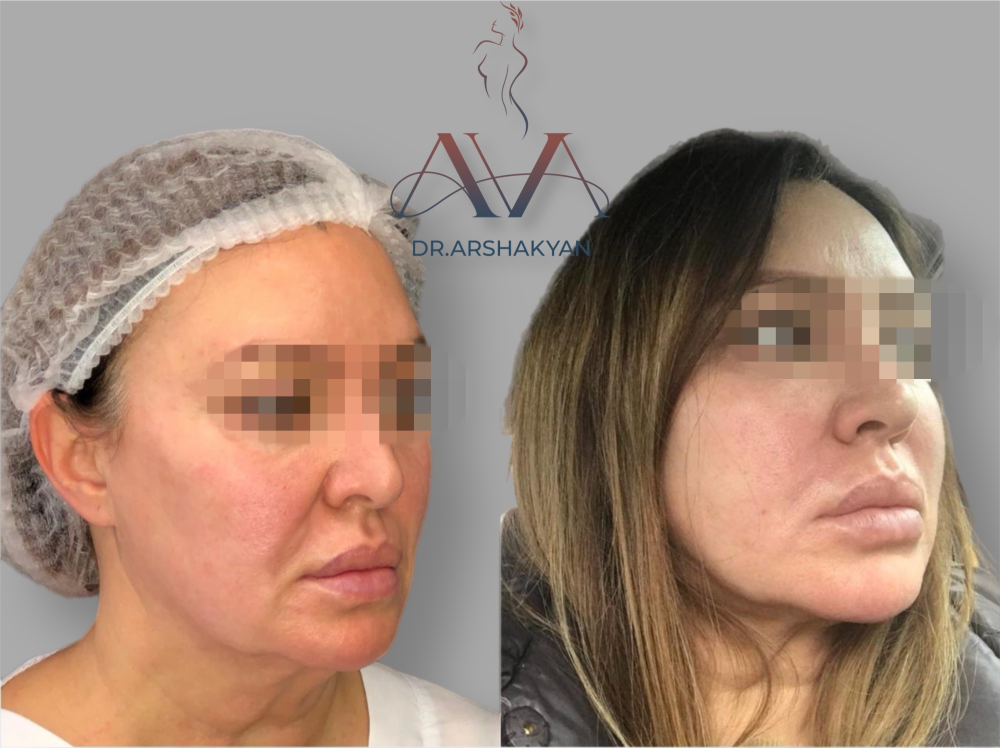 Пациентка пластического хирурга Вардана Аршакяна до и после радиочастотного лифтинга лица FaceTite