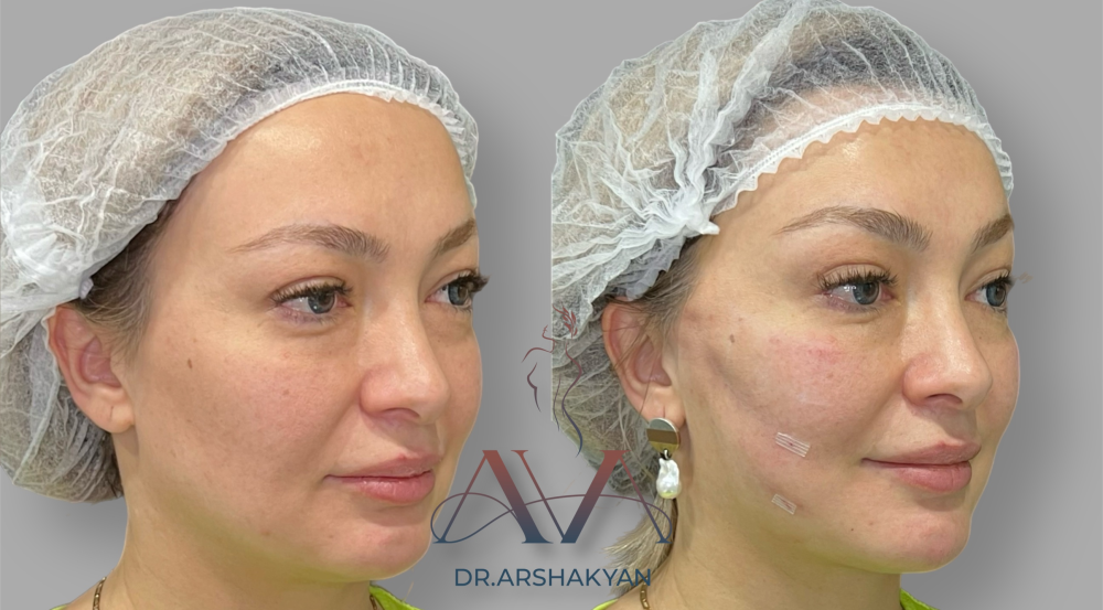Пациентка пластического хирурга Вардана Аршакяна до и после нитевой подтяжки лица