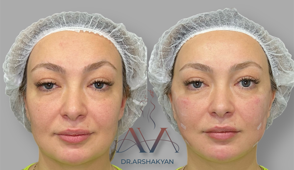 Пациентка пластического хирурга Вардана Аршакяна до и после нитевого лифтинга лица