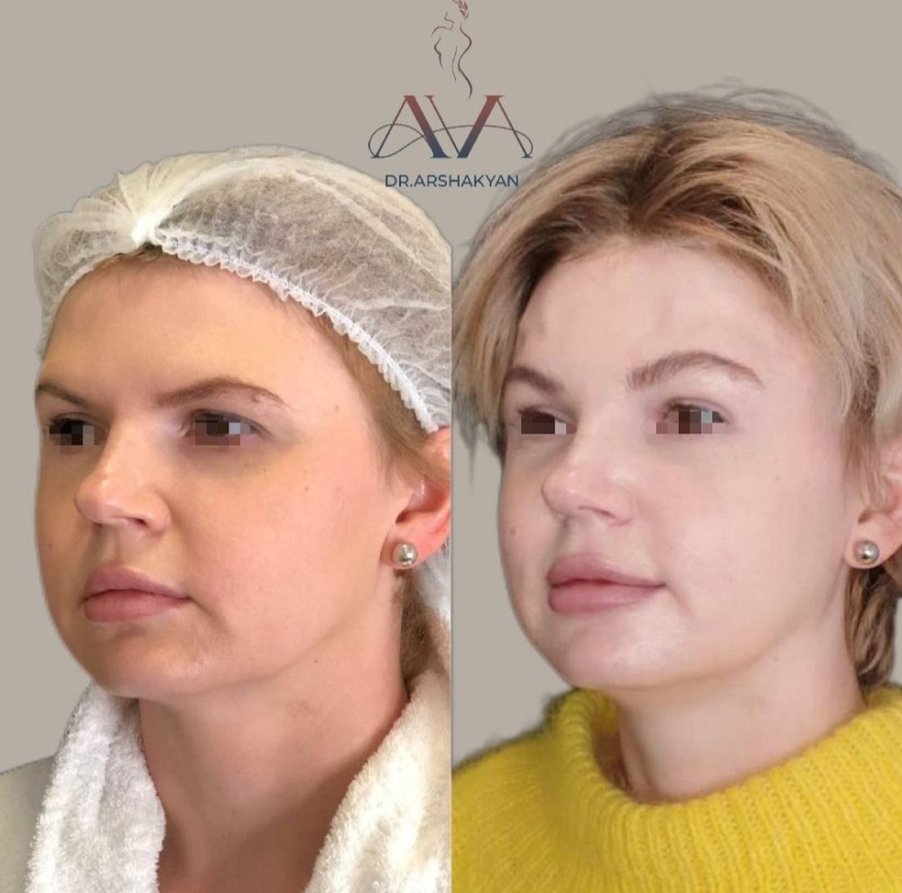 Пациентка Вардана Аршакяна после эндоскопического лифтинга лба