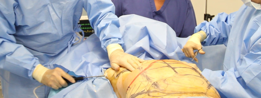 3D High Definition VASER-липосакция операция