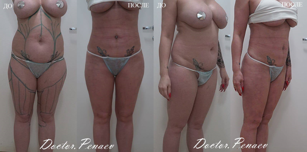Пациентка доктора Пенаева до и после 3D High Definition VASER-липосакции