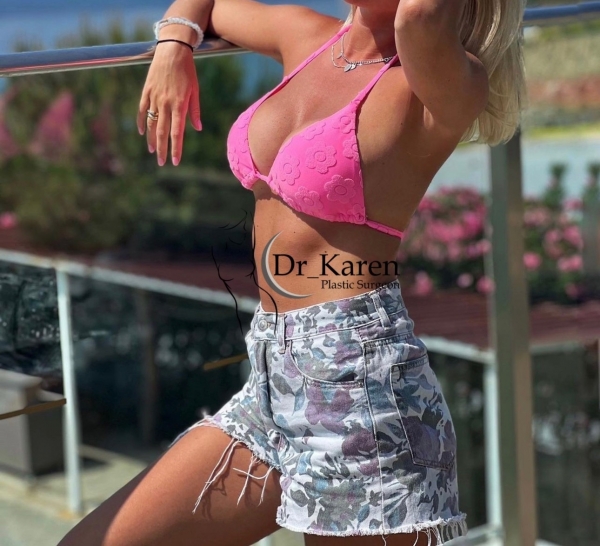 Пациентка пластического хирурга Карена Пайтяна после увеличения груди имплантами. Фотоотзыв