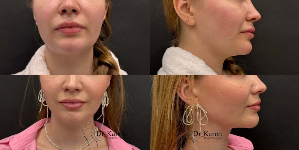 Пациентка Карена Пайтяна до и после липомоделирования подбородка.