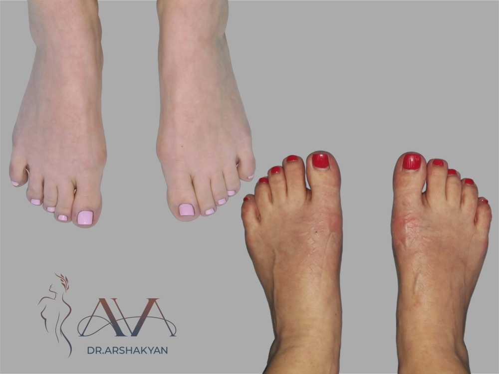 Пациентка пластического хирурга Вардана Аршакяна до и после удаления косточки на стопе