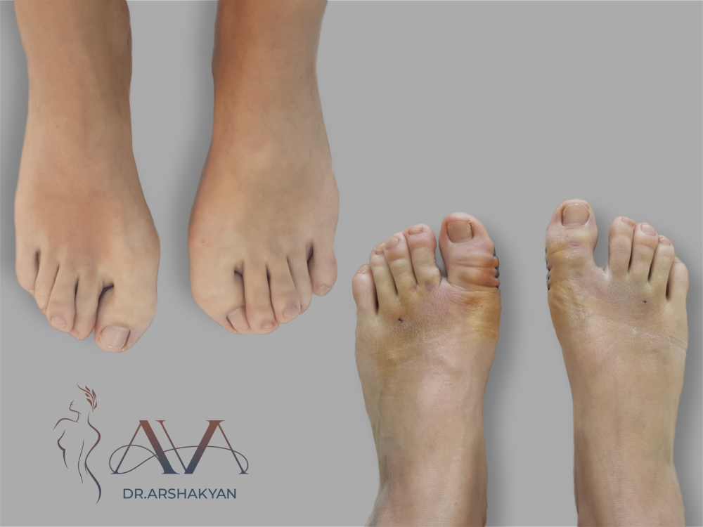 Пациентка пластического хирурга Вардана Аршакяна до и после удаления вальгусной деформации стопы
