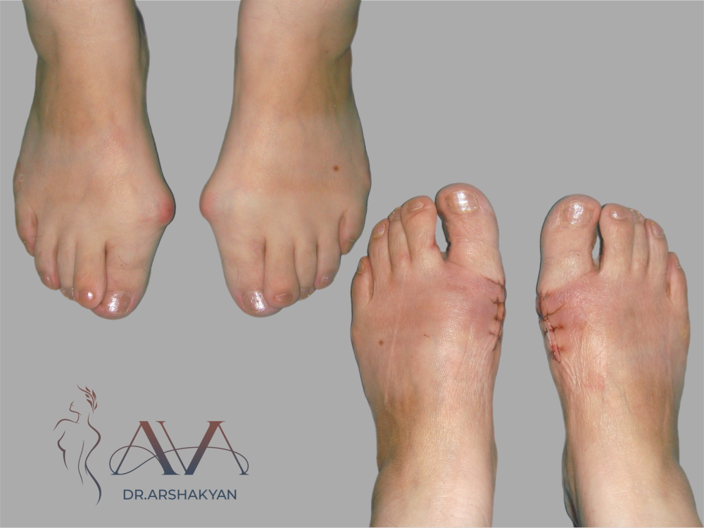 Пациентка пластического хирурга Вардана Аршакяна до и после коррекции вальгусной деформации стопы