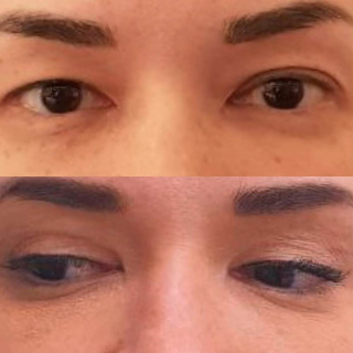 Пациентка доктора Лилит Чолоян на фото до и после коррекции век