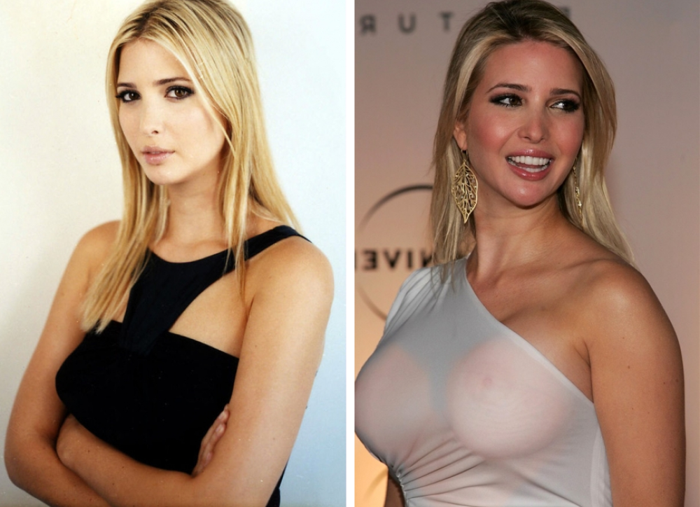 Иванка Трамп до и после увеличения груди имплантами