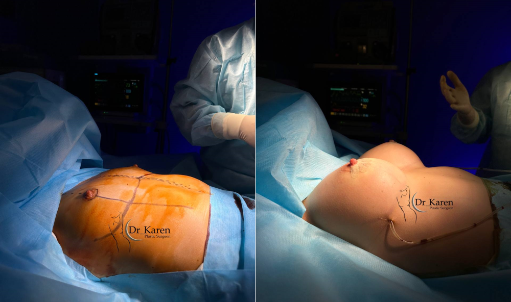 Пациентка доктора Карена Пайтяна до и сразу после увеличения груди имплантами