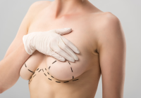 Шрамы от подтяжки груди останутся через год?