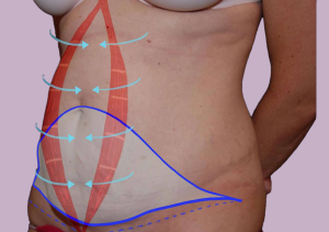 Восстановление мышц живота во время абдоминопластики