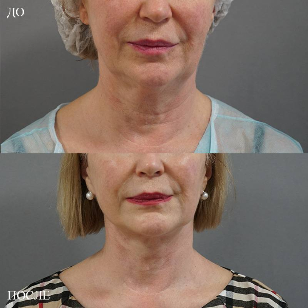 Пациетка доктора А. Пенаева. Выполнен Ultrasound SMAS lifting (SMAS-подтяжка с ультразвуковой диссекцией тканей)