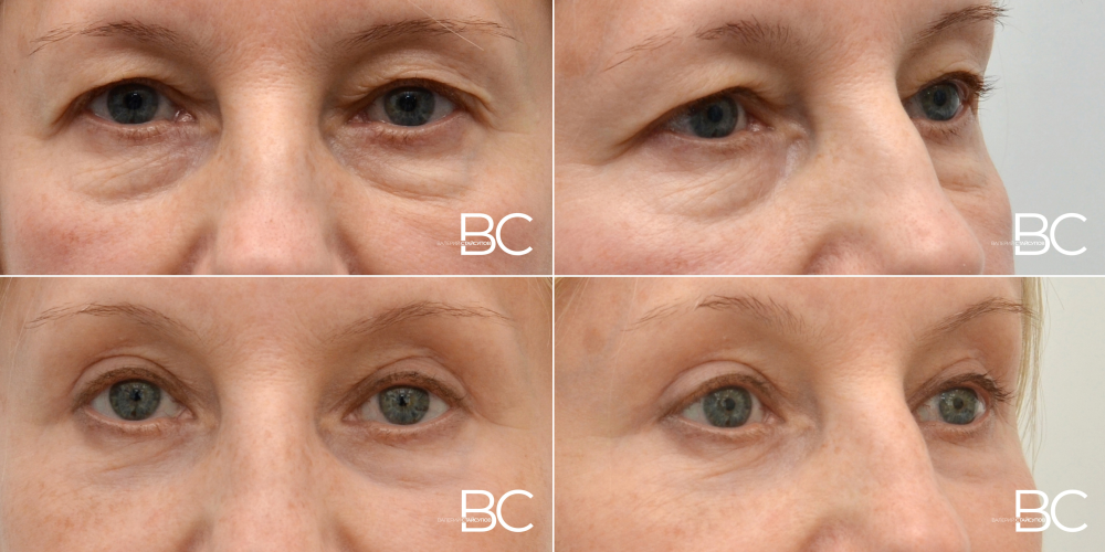 Пациентка доктора Стайсупова до и после верхней и нижней блефаропластики