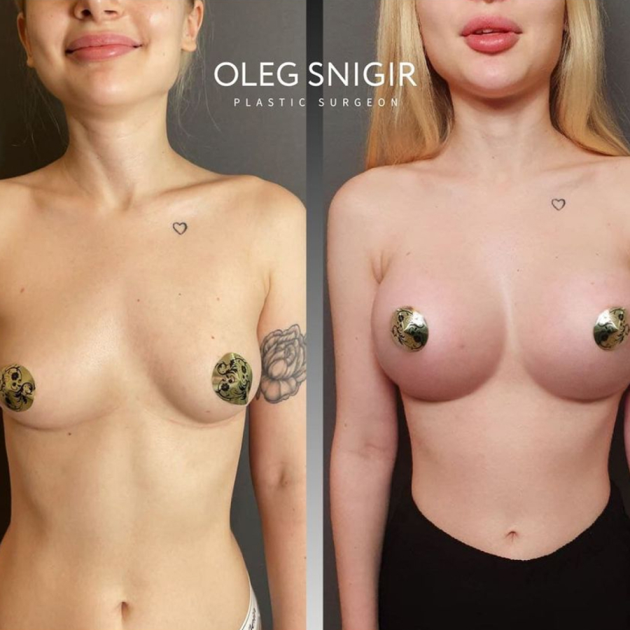Увеличение груди Олег Снигирь