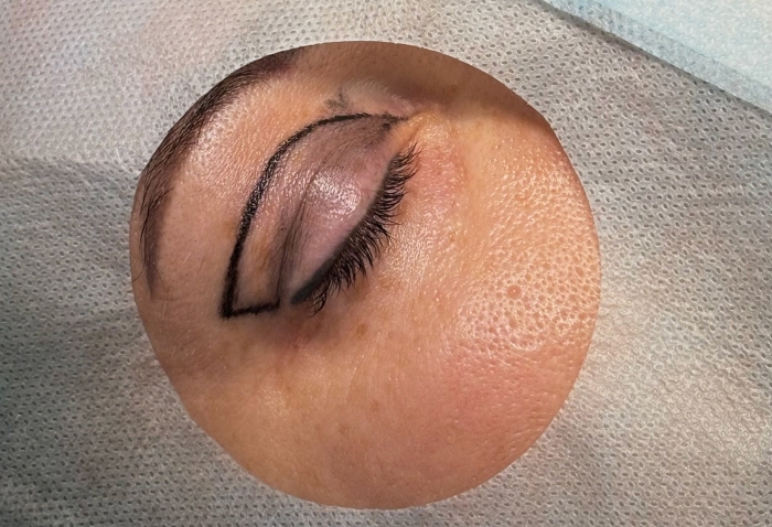 Пациентка перед верхней блефаропластикой