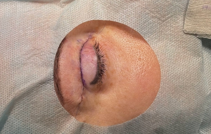 Пациентка после верхней блефаропластики