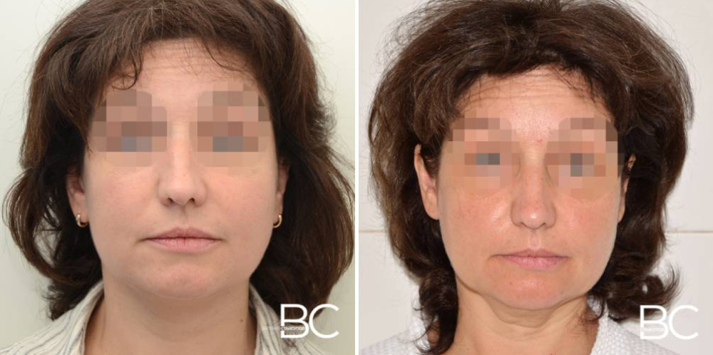 Омоложение лица Валерий Стайсупов