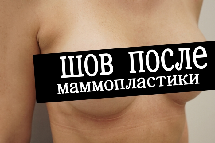 Шов после маммопластики
