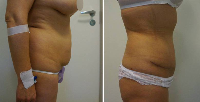 Рубцовая деформация передней брюшной стенки