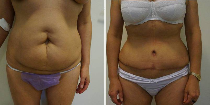 Рубцовая деформация передней брюшной стенки