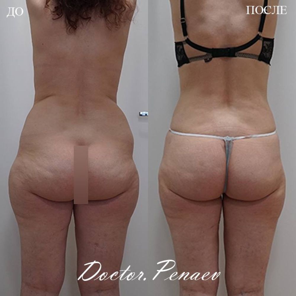 Микрофэтграфтинг удаление целлюлита