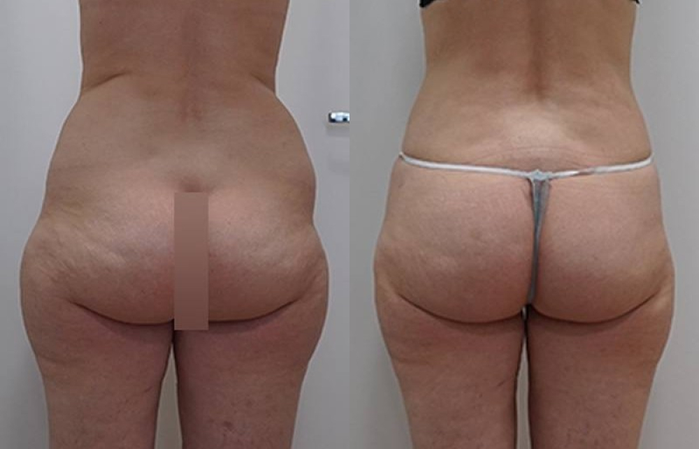 Выполнена гармонизирующая мультизональная VASER-липосакция