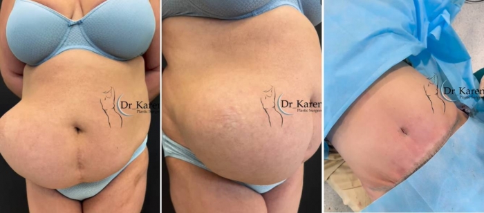 послеоперационная грыжа