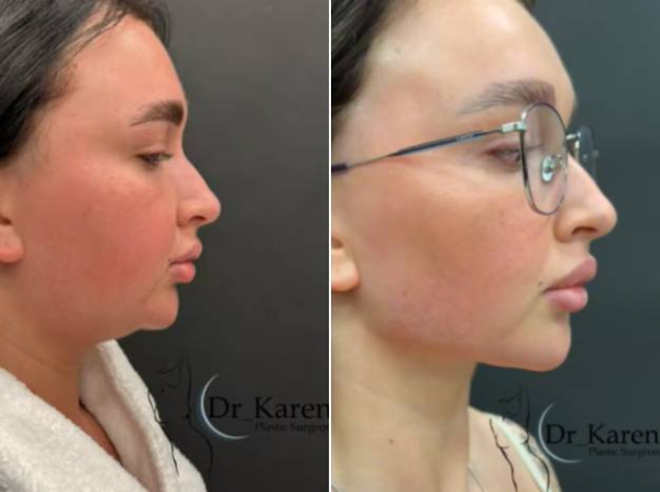 Липомоделирование подбородка до и после Карен Пайтян