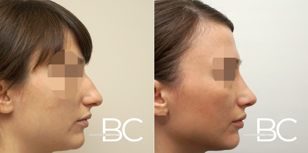 Пациентка доктора В.Ю. Стайсупова до и после ринопластики