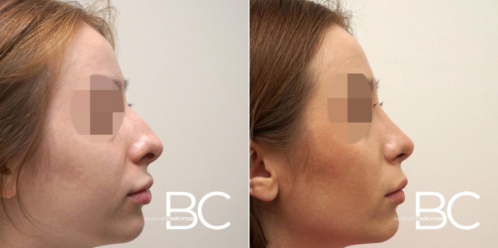 Пациентка доктора В.Ю. Стайсупова до и после ринопластики