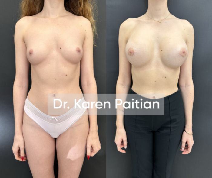 Пластика груди у Карена Пайтяна