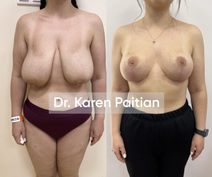 Пластика груди у Карена Пайтяна